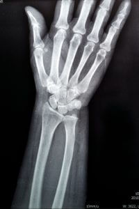 X-ray film of wrist